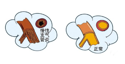 谢锡亮灸法医案之慢性支气管炎艾灸调理