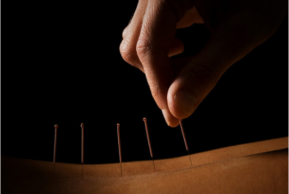 "鬼门十三针"的传奇故事今天给大家介绍的中医针炙之"鬼门十三针"疗法