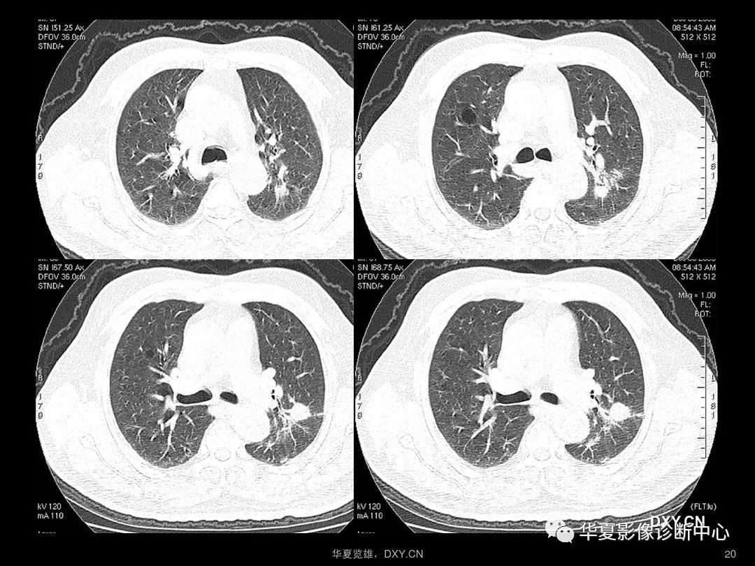 肺炎ct和肺癌ct图片