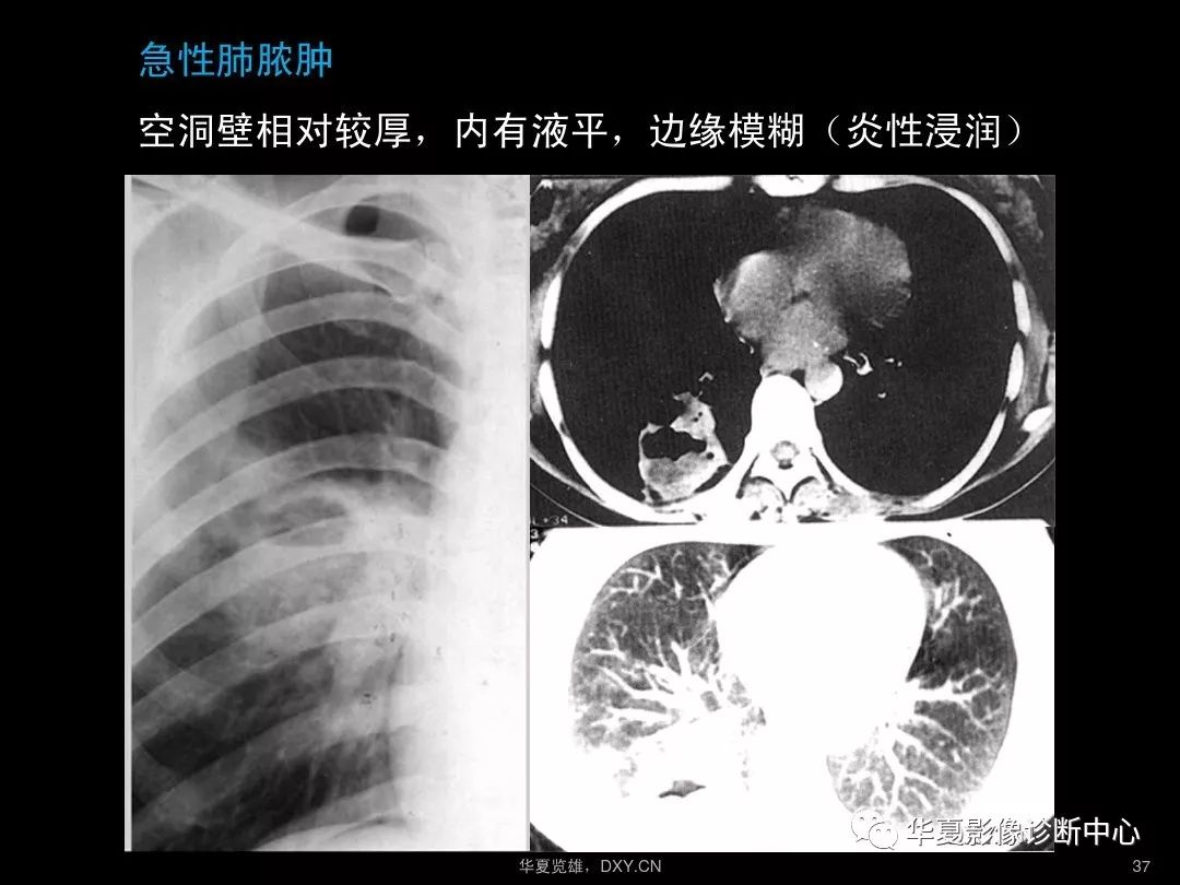 肺炎,肺結核,肺癌在ct及胸片上的區別