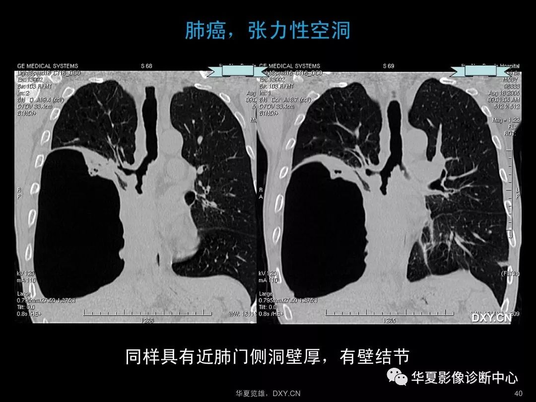 肺炎,肺結核,肺癌在ct及胸片上的區別