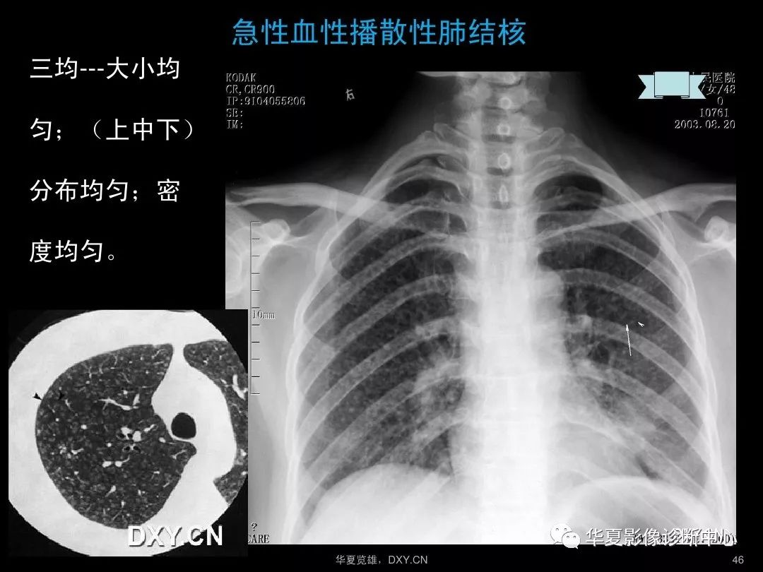 肺炎,肺结核,肺癌在ct及胸片上的区别