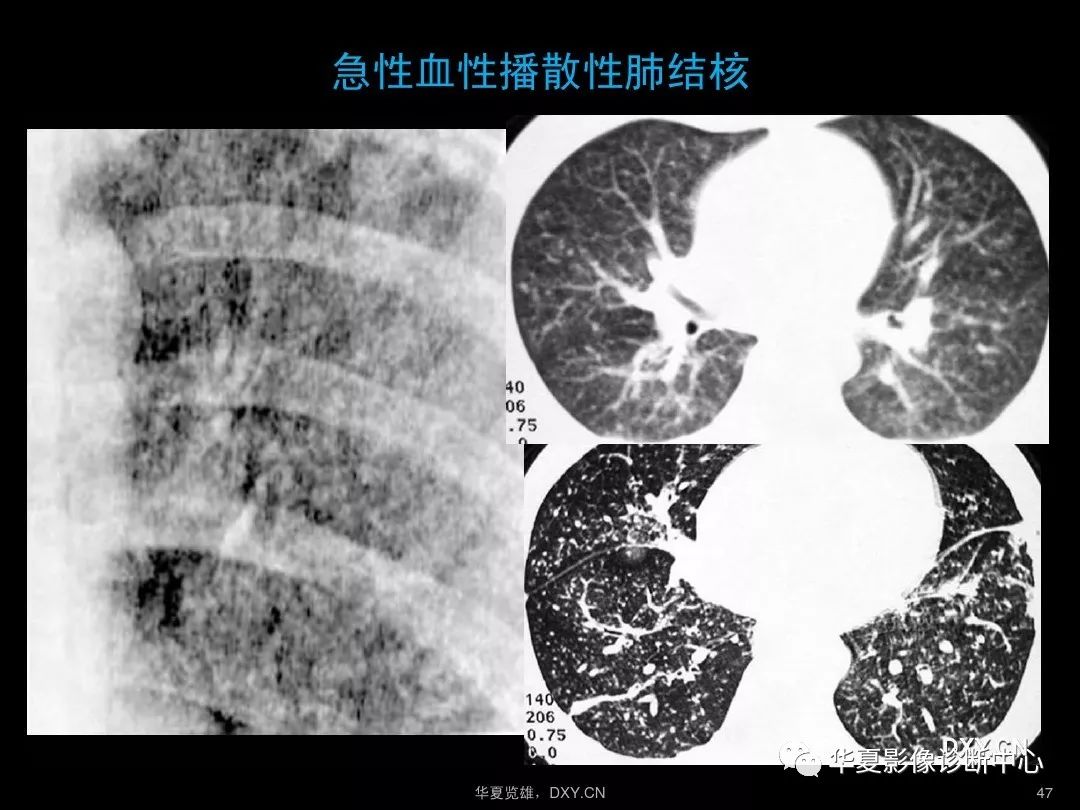 肺炎,肺結核,肺癌在ct及胸片上的區別