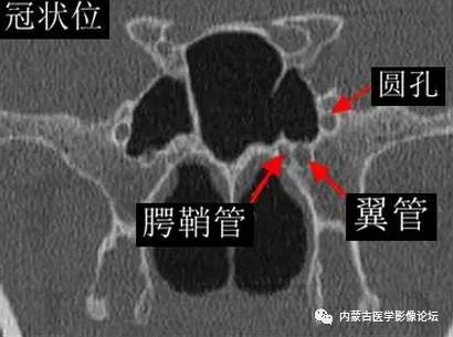 翼腭窝解剖及影像