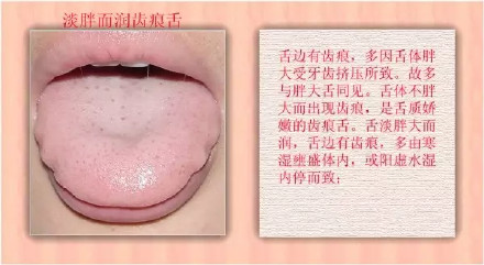 血虚健康的舌头