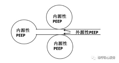这样气道狭窄的患者,外源性peep作用在于撑开小气道对抗内源性peep