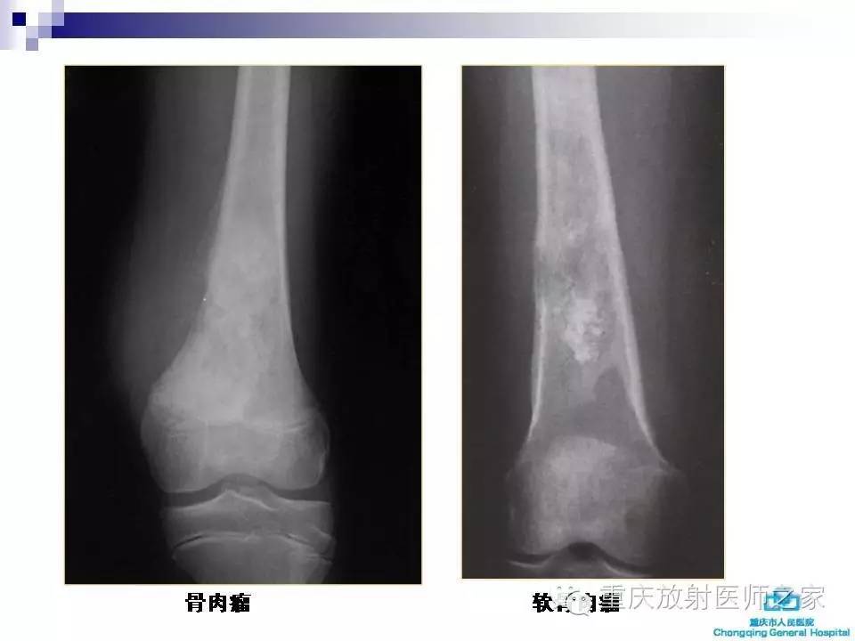 常见骨肿瘤与肿瘤样病变的影像学分析与诊断