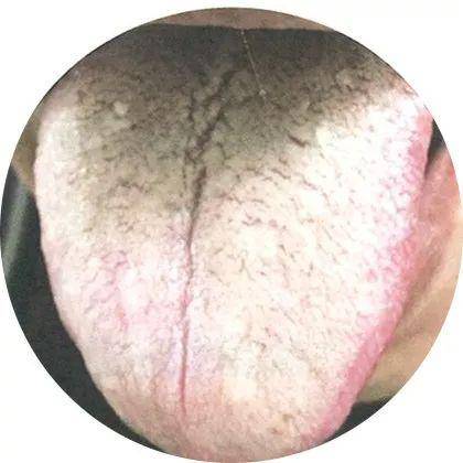 小儿常见草莓舌