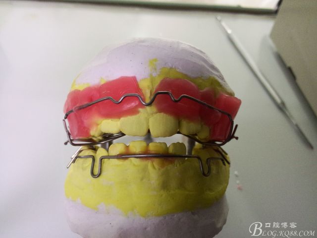 fr3型功能性矫治器的制作过程