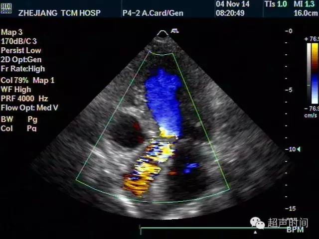 多图文解析主动脉瓣狭窄的超声诊断