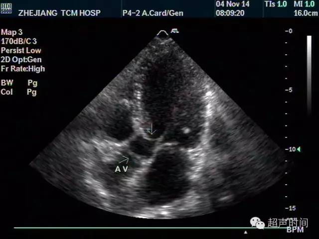 主动脉瓣无冠瓣超声图图片