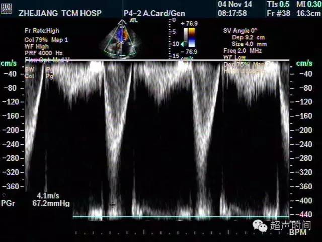 多图文解析:主动脉瓣狭窄的超声诊断