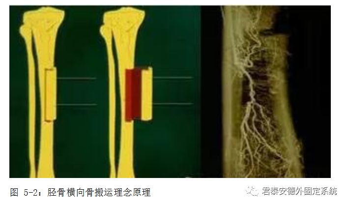 "横向骨搬运原理"应用案例及术后护理