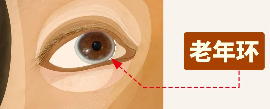 老年环   老年环指黑眼球边缘的一圈灰白色,宽约1～2毫米的环状结构