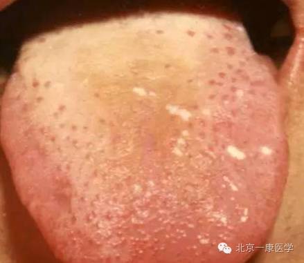 珍贵中医舌诊图解大全图文并茂再也不怕看不懂舌头了