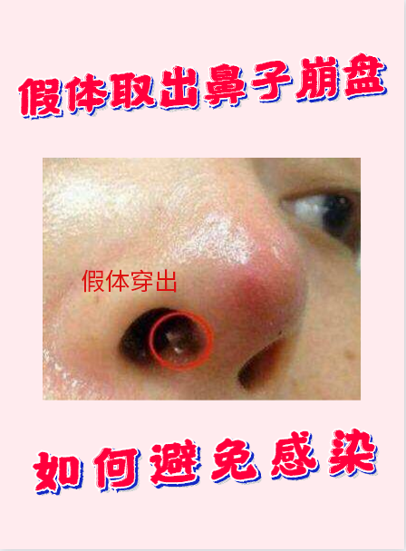 研一精科假体隆鼻假体取出鼻子崩盘如何避免感染