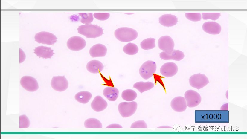19講座視頻外周血紅細胞形態標準化報告和病例分析