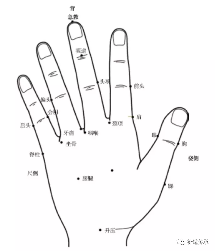 针灸名家金伯华手针治痛简单又实用