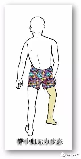 图7 臀中肌无力步态(trendelenburg gait 特伦佰氏步态):臀中肌起到