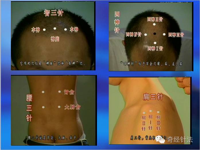 靳三针绝技(内部)