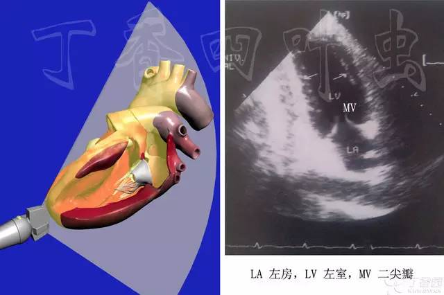 所以不再展開,親們自己查閱資料,在心尖四腔和二腔切面測量計算 e