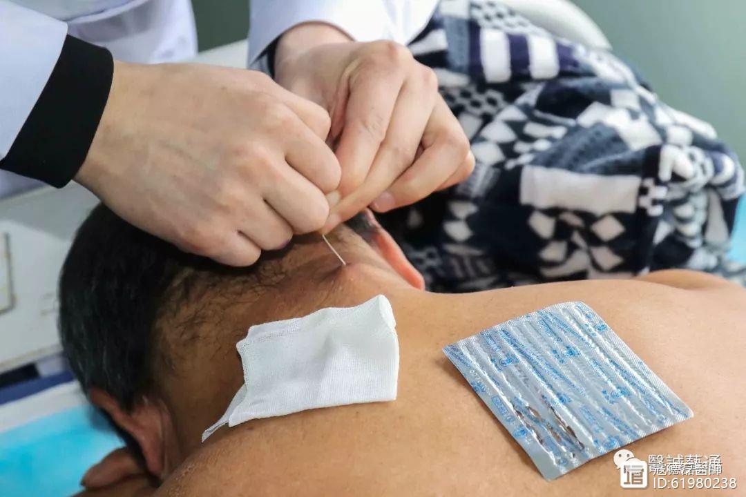 原中医针刺手法搓法附滞针术及滞针疗法的临床与应用