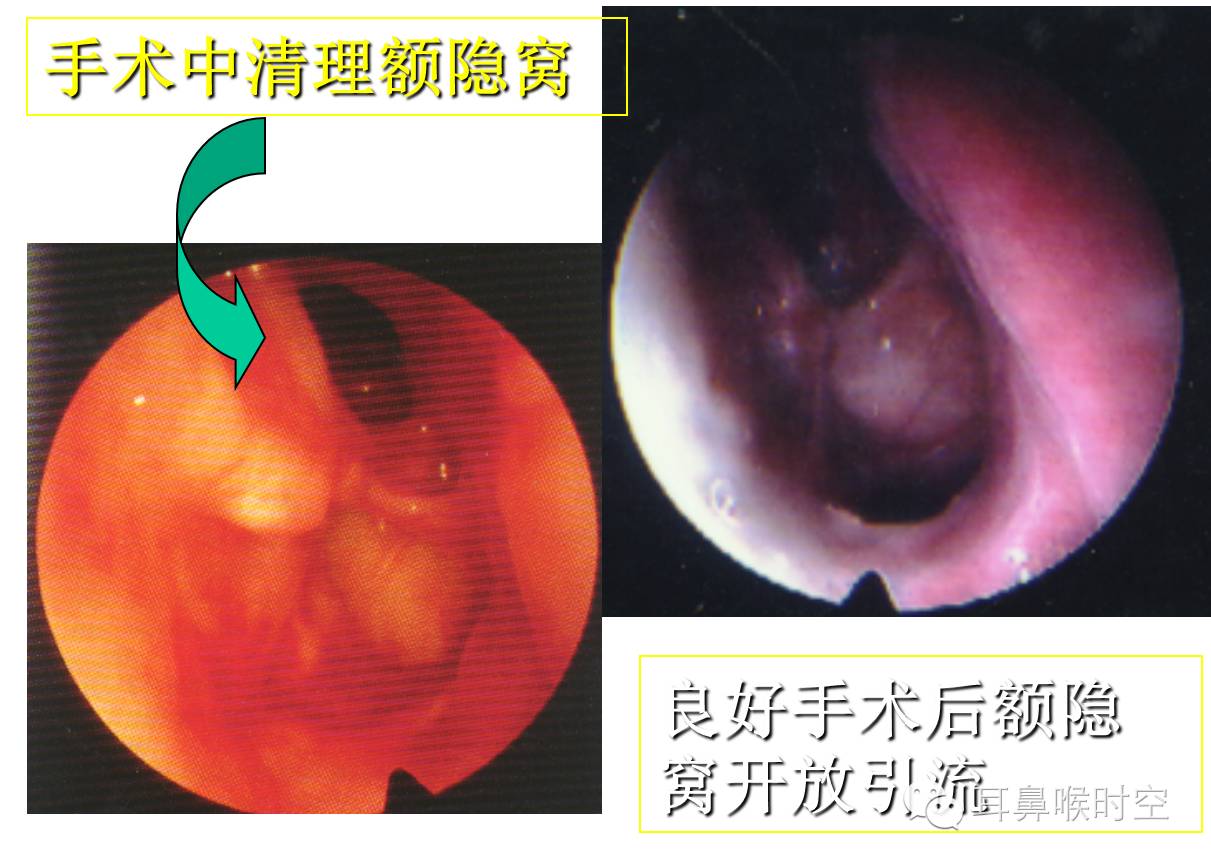 蝶窦区域解剖最后筛房与视神经onodi气房onodi气房的出现率:48%如以视