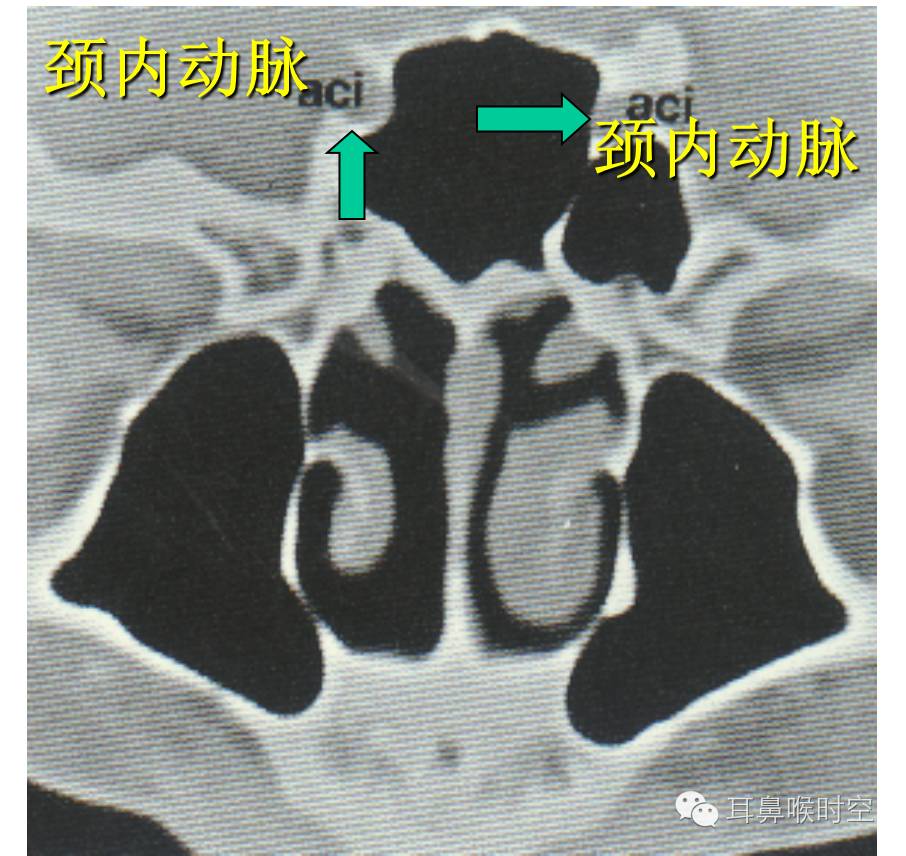 颈内动脉与视神经结节的位置关系发育良好的最后筛房外侧壁上可能出现