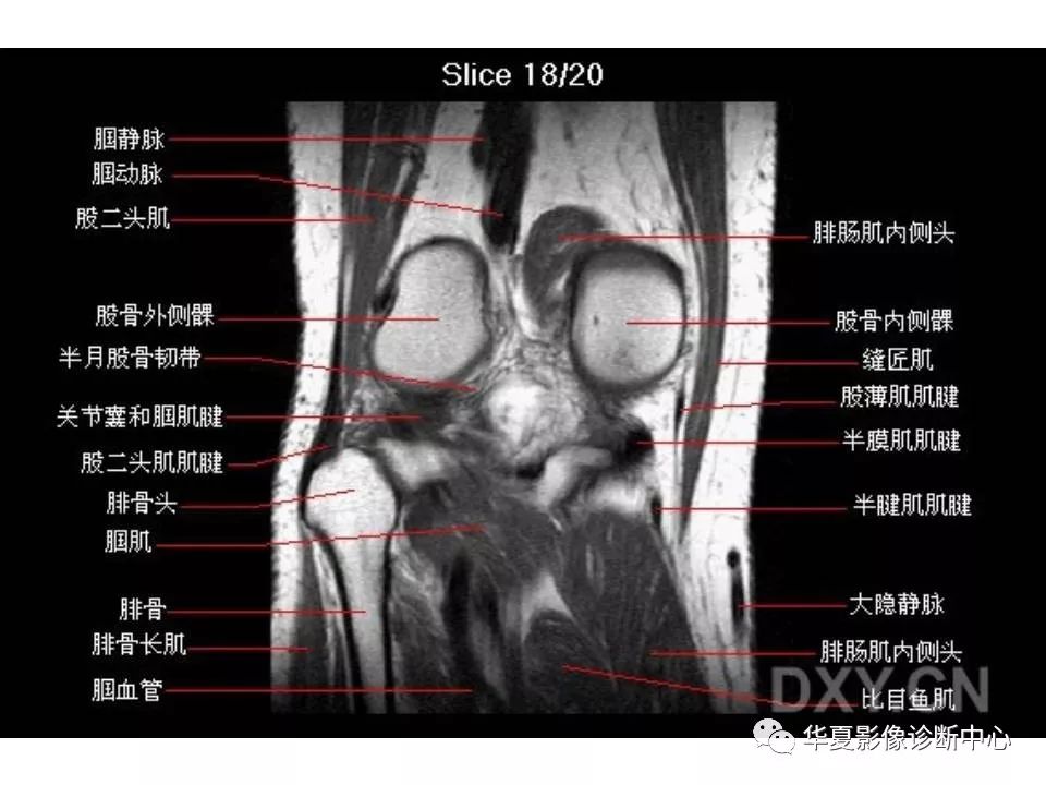 詳細的膝關節mri解剖標識