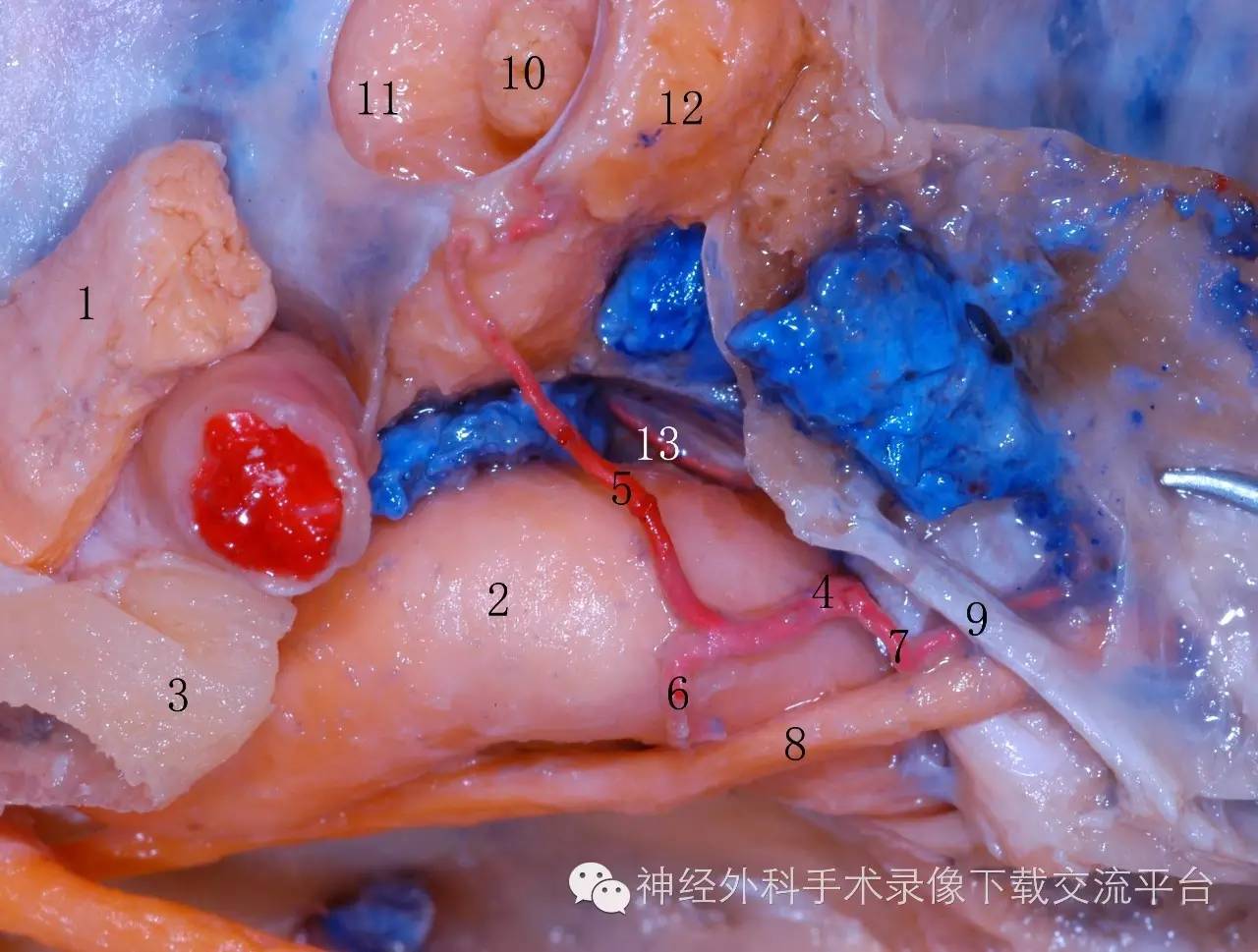 圖2-4-4腦膜垂體幹1視神經2頸內動脈海綿竇段3前床突4腦膜垂體幹5垂體