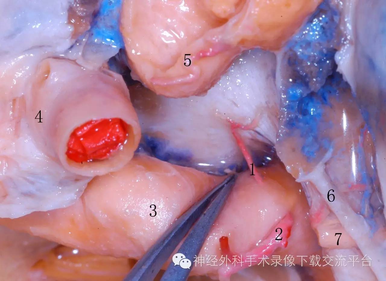 【解剖】海綿竇區手術解剖--於春江 - 好網角收藏夾