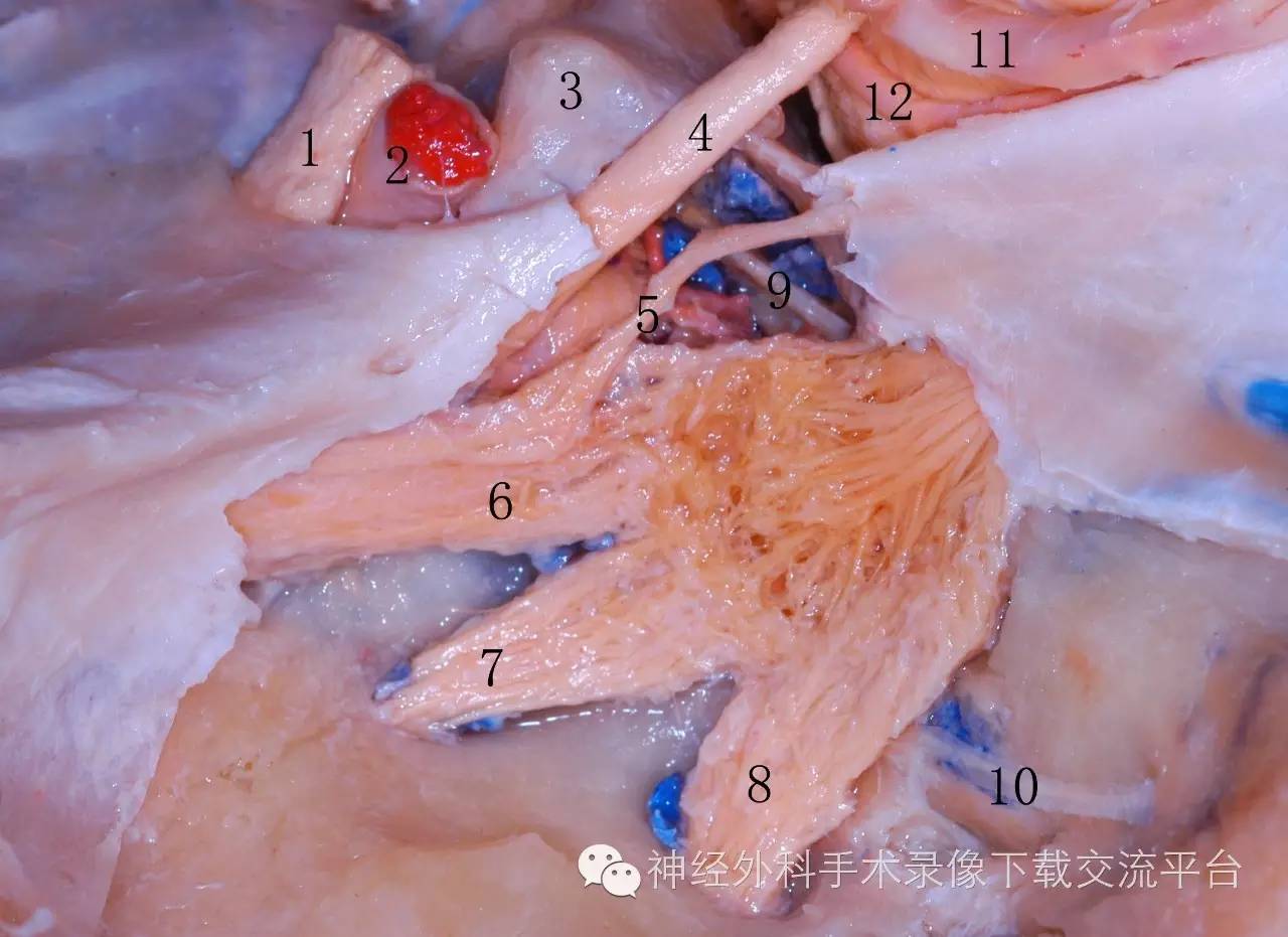 神经9蝶岩韧带10岩浅大神经11大脑后动脉12小脑上动脉图2-4-10海绵窦