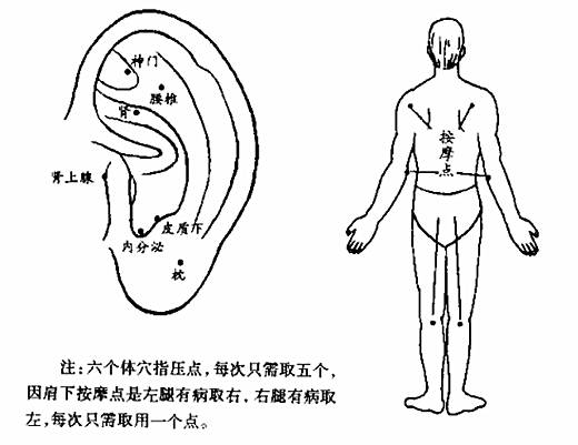 人体x形平衡法3243腰椎间盘突出症的火柴棒压耳穴