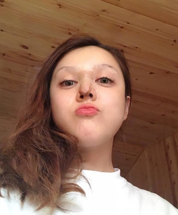 隆鼻假体取出疼吗假体隆鼻取出来鼻子会变形吗