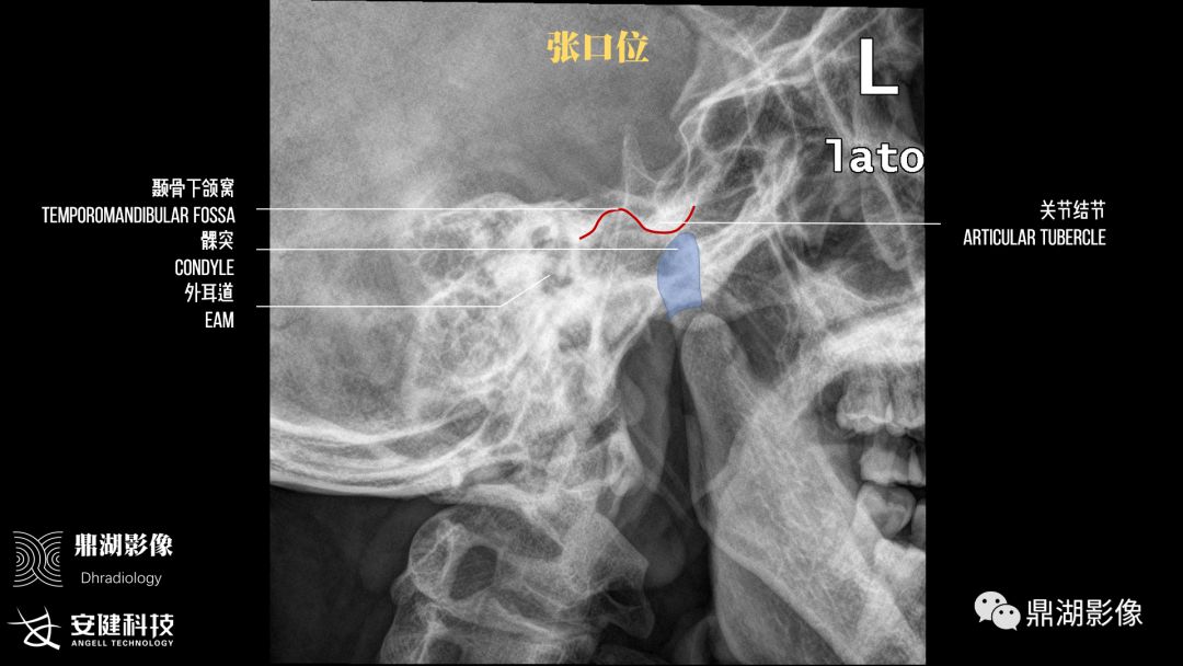 x线高清图谱 精致颞下颌关节解剖x线高清图谱 寰枢关节半脱位诊断