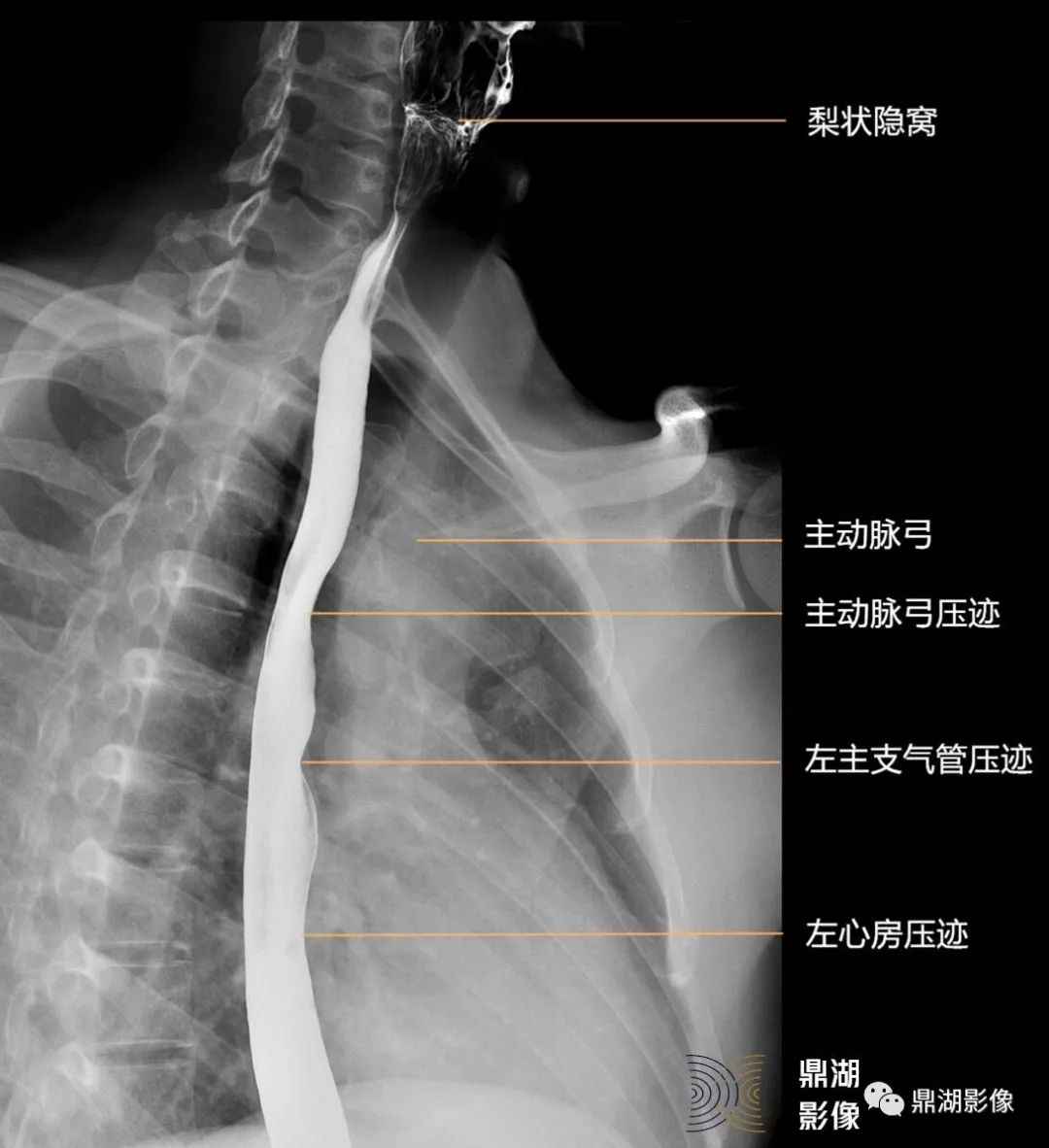 食管造影下嚥部造影x線高清圖譜 | 食管造影解剖mlo位cc位x線高清圖譜