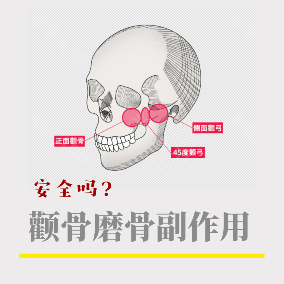 颧骨磨骨手术有什么风险和后遗症,颧骨磨骨多久能恢复?