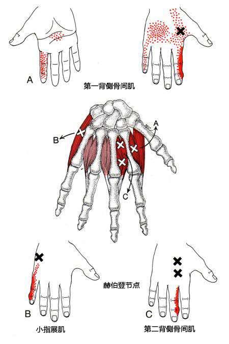 12第一背侧骨间肌扳机点