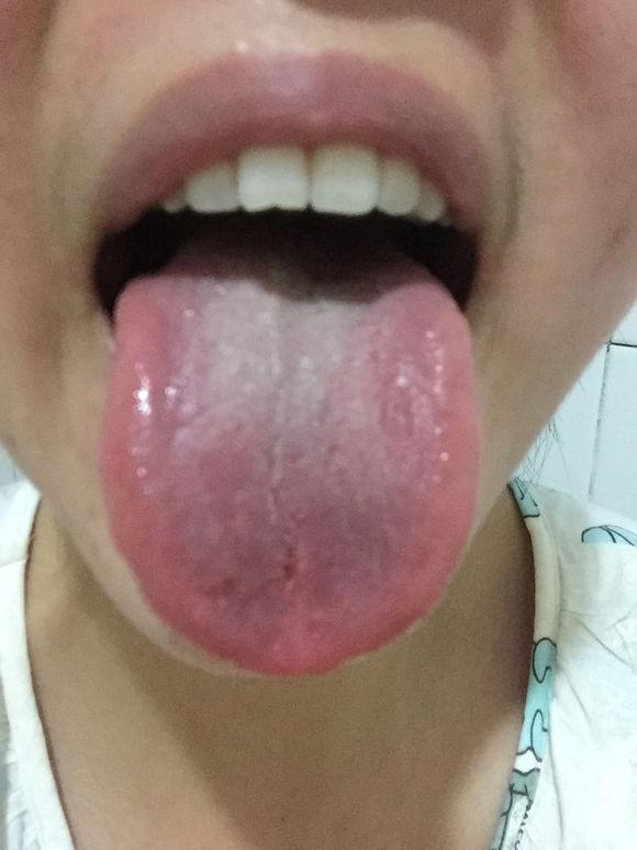 胃阴虚的舌苔图片图片