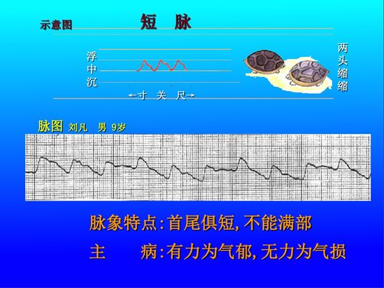 洪脉【脉象特征】脉体阔大,状如洪水,来盛去衰.