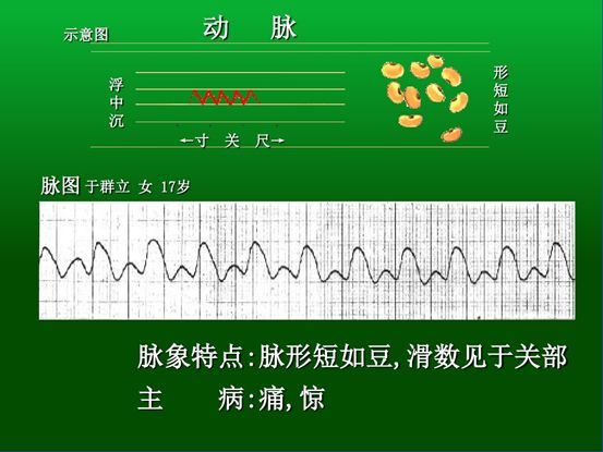 促脉【脉象特征】急数而又不规则,间歇性停顿.主病阳热亢盛.
