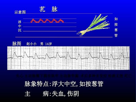 脉诊图解大全28种脉象让你快速掌握脉诊