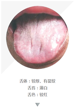 舌体:较厚,有裂纹舌苔:薄白舌色:较红此舌象提示少阳风火,痰湿上扰.