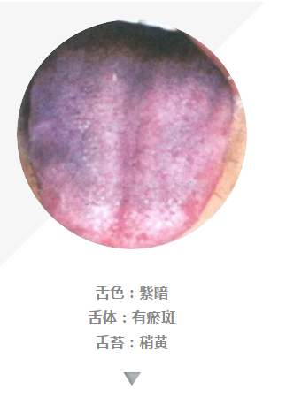 舌质:紫暗   舌苔:薄白   舌体:适中,有瘀点   这种舌象多由心血瘀