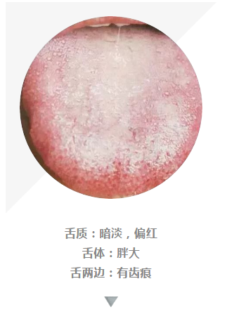 1  齿痕舌,白厚腻苔