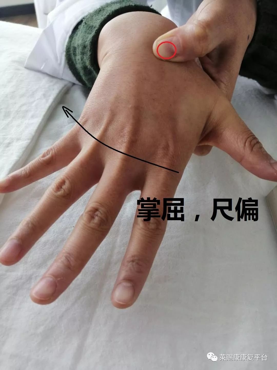 前臂旋前,腕关节中间位,手指尖放在桡骨茎突的远侧桡侧位置.