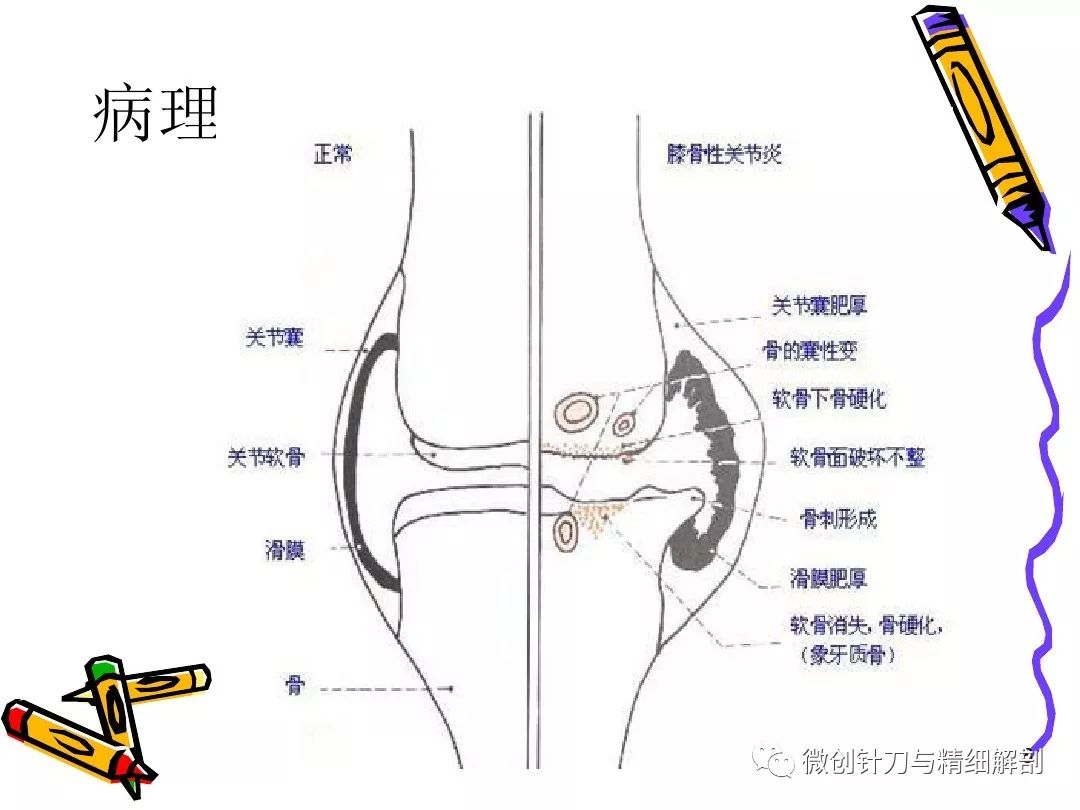 膝关节解剖图 滑膜囊图片