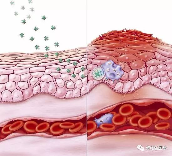 與夏季皮炎治療方法不同,秋季性皮炎治療不再是清熱祛溼,而是注重滋陽