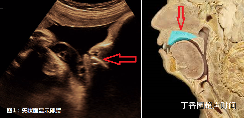 腭裂超声图片图片