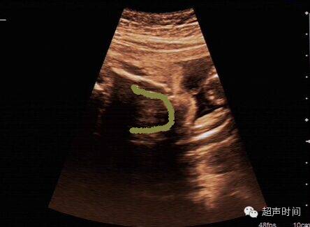 经下颌斜冠状切面:硬腭呈平直,弧形强回声带,动态观察显示其呈马蹄形